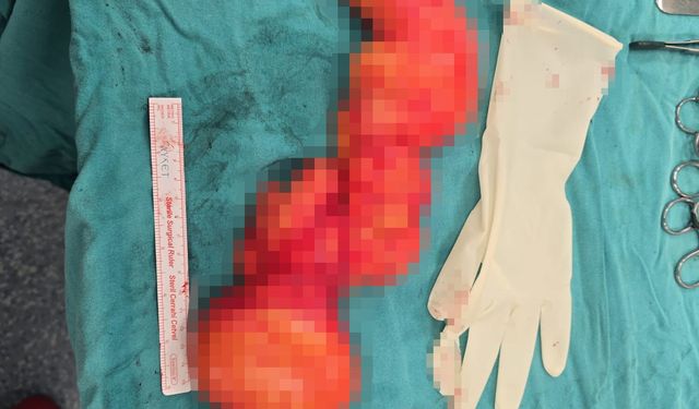 Sırtındaki 10 yıllık kitlenin içinden 1 buçuk kilogramlık tümör çıktı